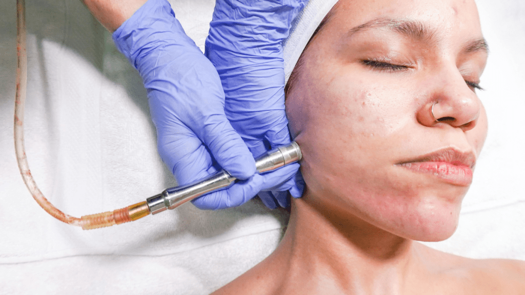 Understanding Microdermabrasion Treatment and How You’ll Benefit