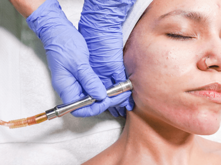 Understanding Microdermabrasion Treatment and How You’ll Benefit