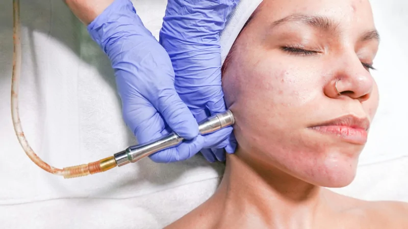 Understanding Microdermabrasion Treatment and How You’ll Benefit